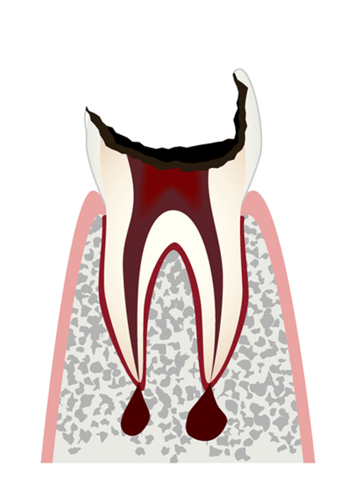 歯の頭の部分（歯冠）が失われた歯